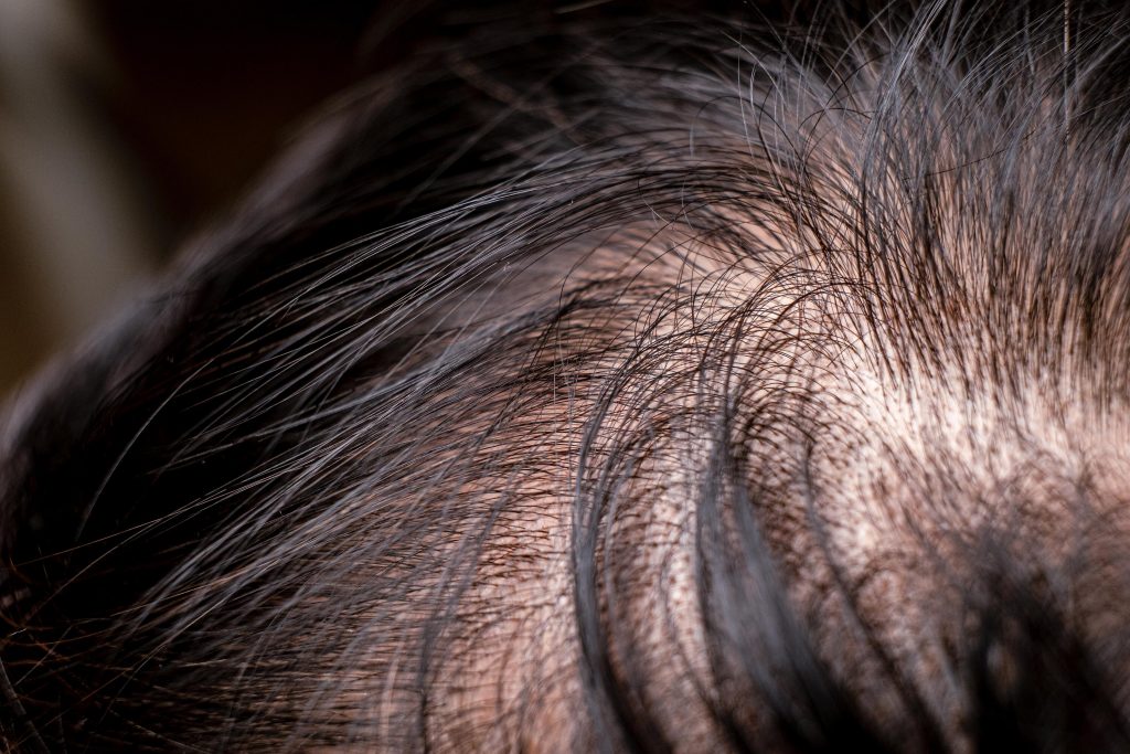 Case Study Improving hair density after several hair transplants