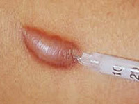corticosteriod injections