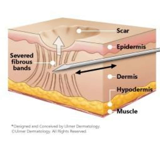 subcision and fillers