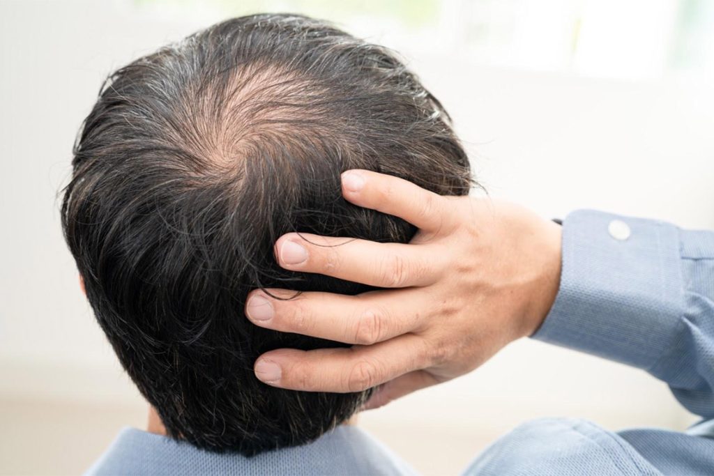 hair transplant singapore
