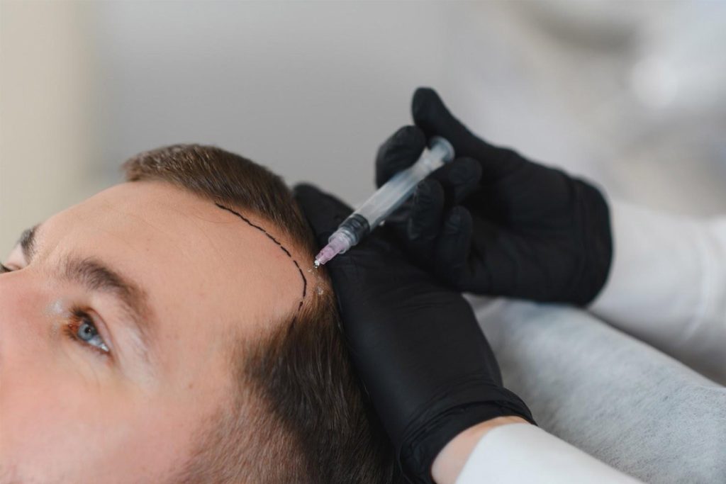hair transplant Singapore cost