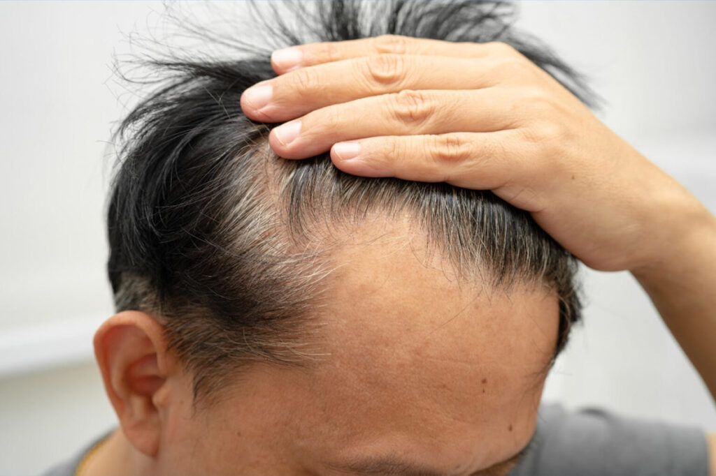 hair transplant singapore cost male